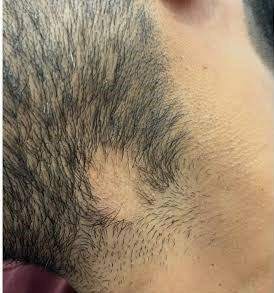 Beard Patch Loss