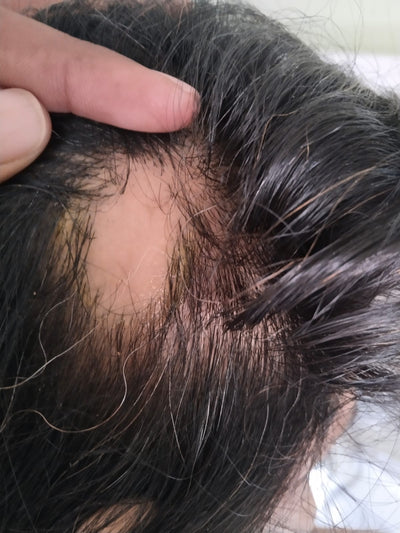 Alopecia Areata