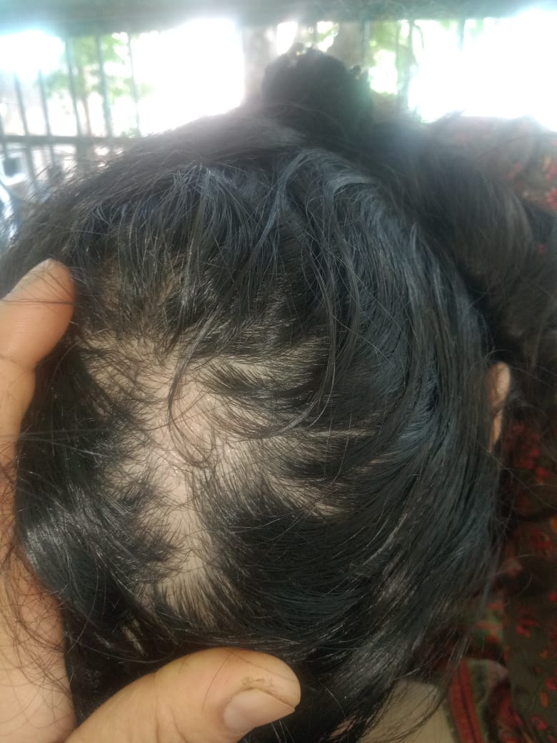 Alopecia Hair Patch Solution | 10ml Roll-On
