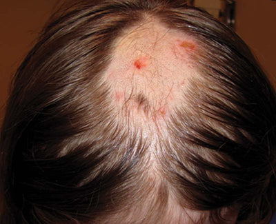 Trichotillomania