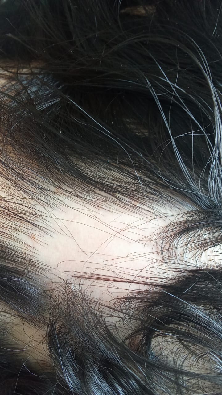 Alopecia Hair Patch Solution | 10ml Roll-On