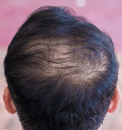Telogen Effluvium