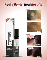 Alopecia Hair Patch Roll - On | #1 Highly Rated & Effective Formula