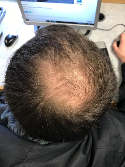 Male Pattern Baldness