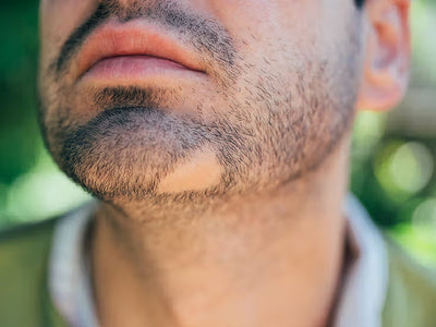 Beard Alopecia