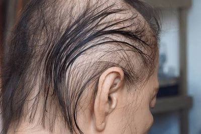Chemotherapy Hair Loss