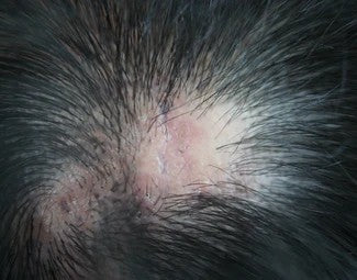 Scarring Alopecia
