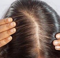 Female Pattern Hair Thinning
