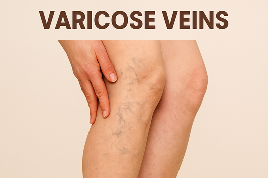 Varicose Veins: Understanding the Condition, Its Causes, and a Natural Path to Recovery