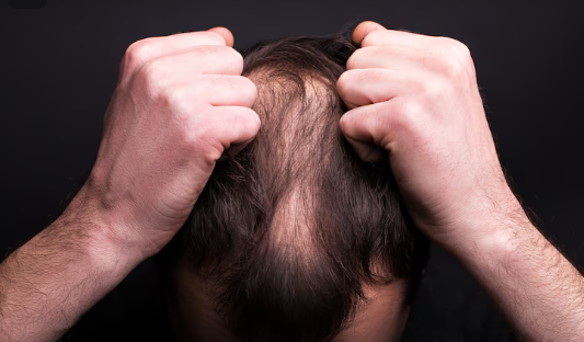 Understanding Alopecia: Causes, Types, and Care Tips