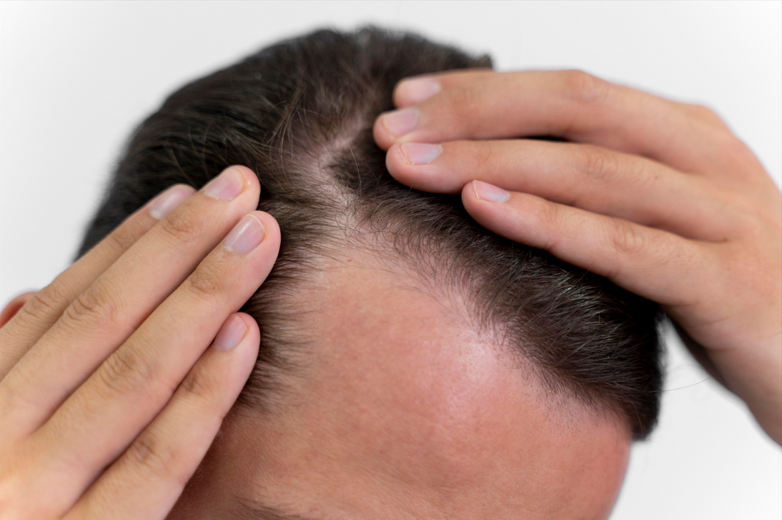 Understanding Alopecia: Breaking the Stigma Around Hair Loss