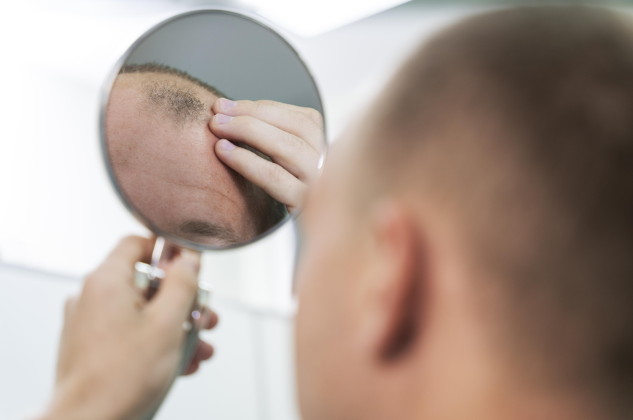 Best Care for Alopecia: Natural Ways to Restore Hair and Confidence