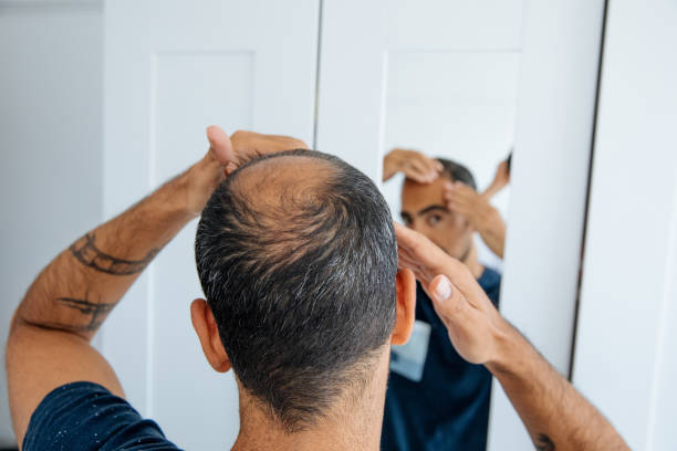Unmasking Alopecia: Understanding Hair Loss & Discovering Effective Solutions (Including Hair Patches!)