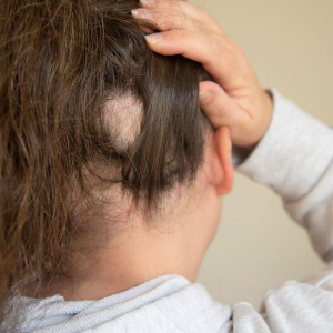 That Bald Patch on Your Head Has a Name — and It's More Common Than You Think