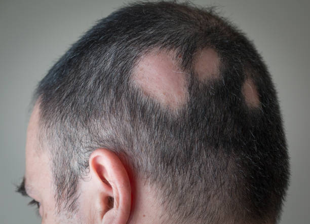 Understanding Alopecia: What You Should Know