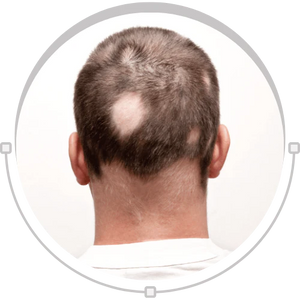 Alopecia areata hair loss concern