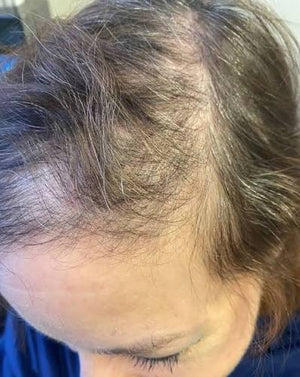 Alopecia areata hair loss concern