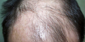 Scarring alopecia hair loss concern