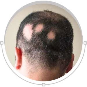 Scarring alopecia hair loss concern