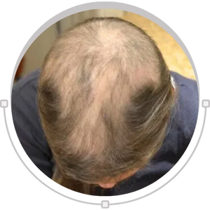 Trichotillomania hair loss concern