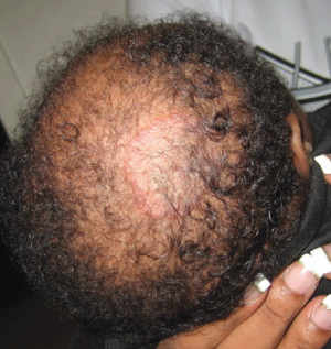 Trichotillomania hair loss concern