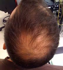 Male hair loss concern