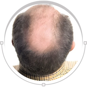Male hair loss concern