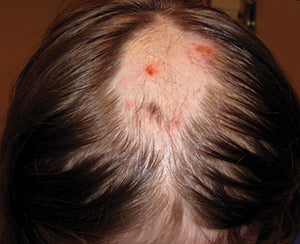 Beard hair patch loss concern