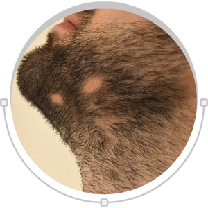 Beard hair patch loss concern