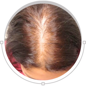 Female hair baldness concern