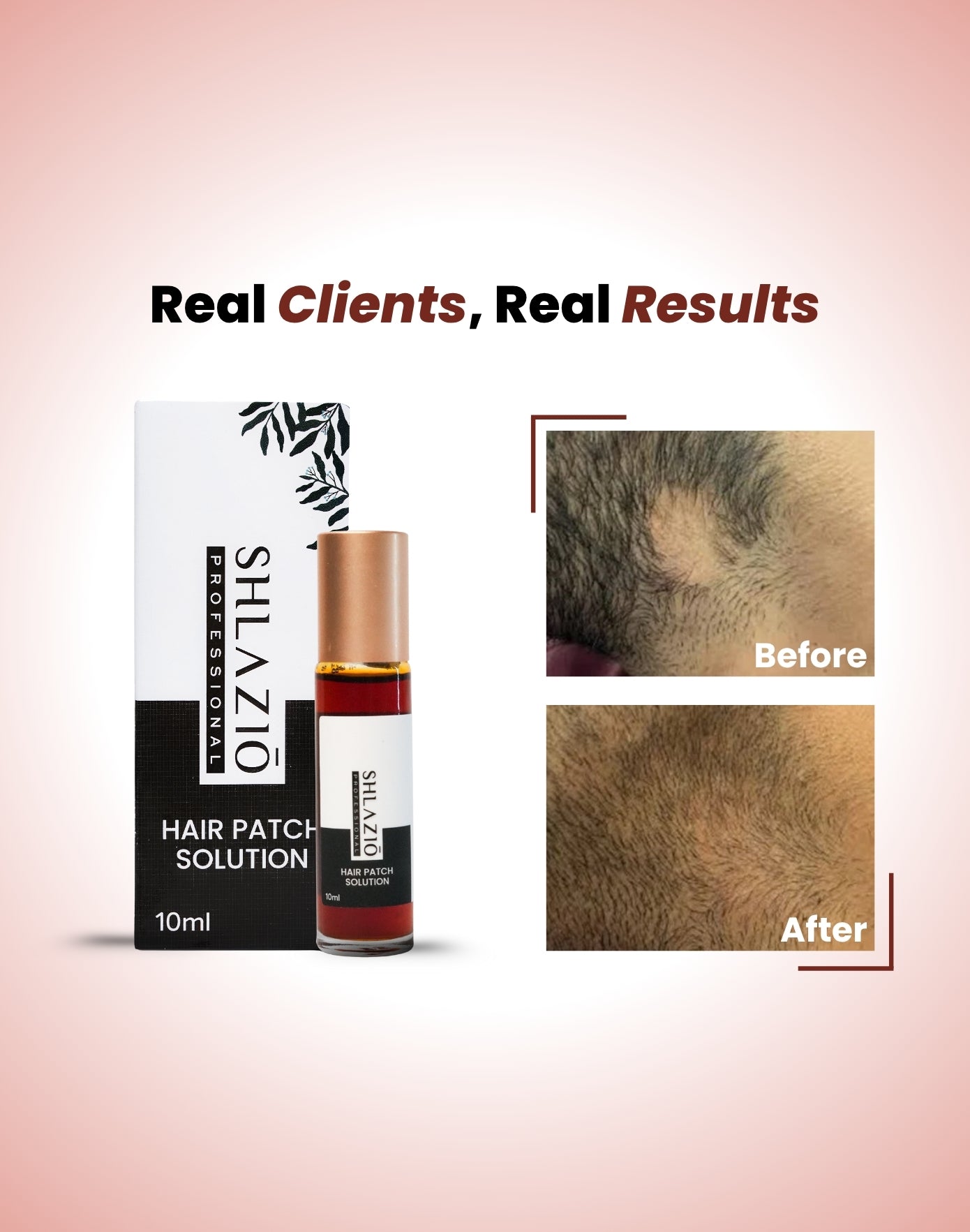 Alopecia Hair Patch Roll - On | #1 Highly Rated & Effective Formula