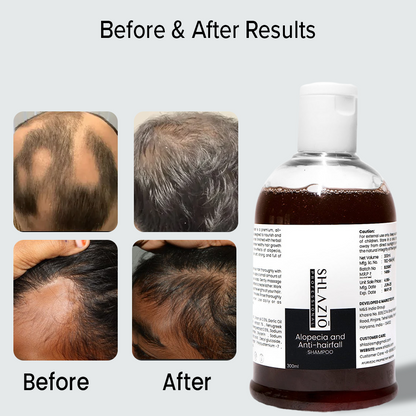 Alopecia and Anti-hair Fall Shampoo | 300 ml