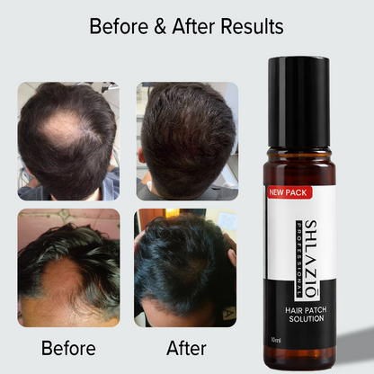 Alopecia Hair Patch Roll - On | #1 Highly Rated & Effective Formula