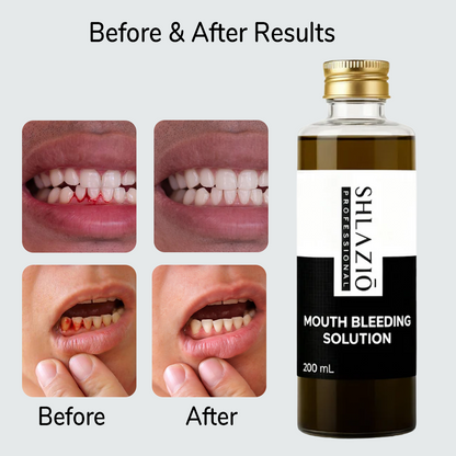 Mouth Bleeding Solution | 200 ml (For Bleeding Gum)