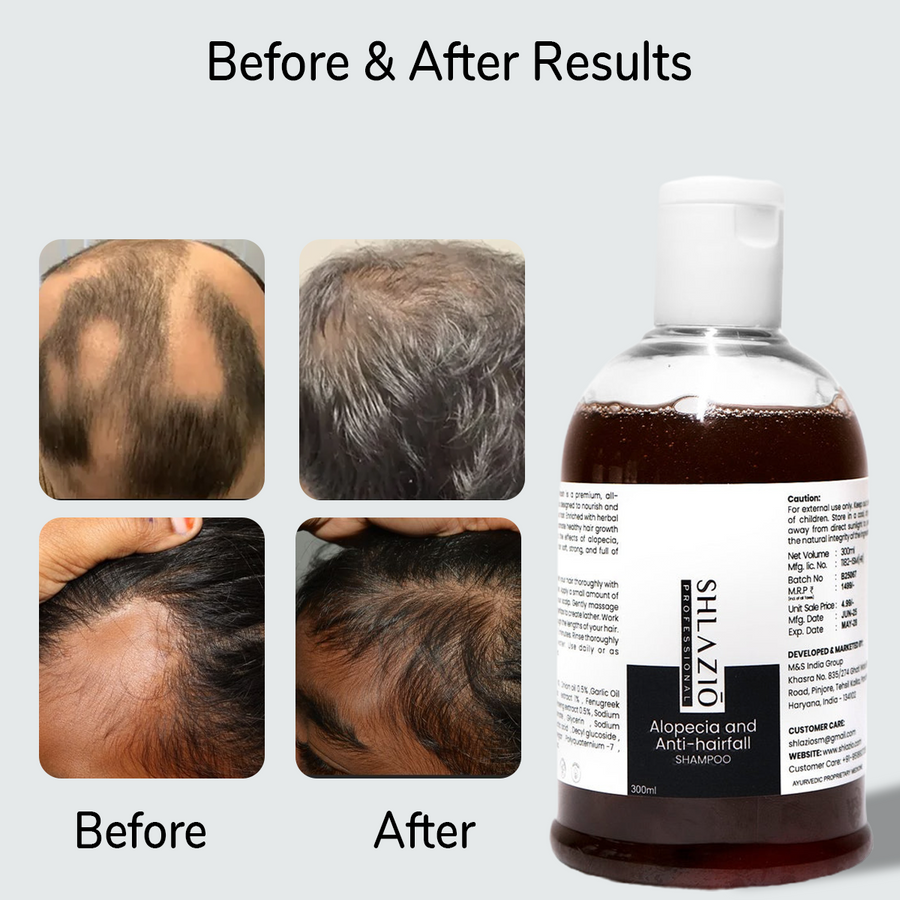 Alopecia and Anti-hair Fall Shampoo | 300 ml