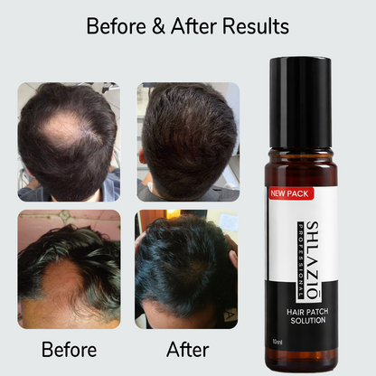 Alopecia Hair Patch Roll - On | #1 Highly Rated & Effective Formula
